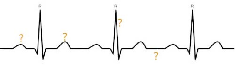 EKG